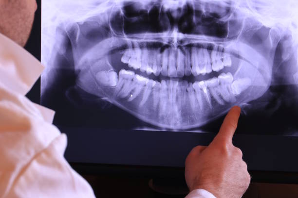 Best Emergency Wisdom Teeth Removal in Lakefield, MN